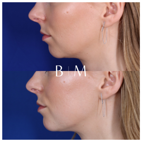 Dermal Filler case #5447