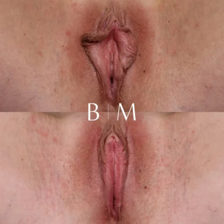 Labiaplasty case #6344