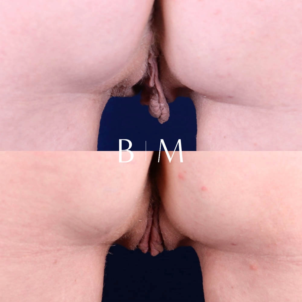 Labiaplasty case #6344