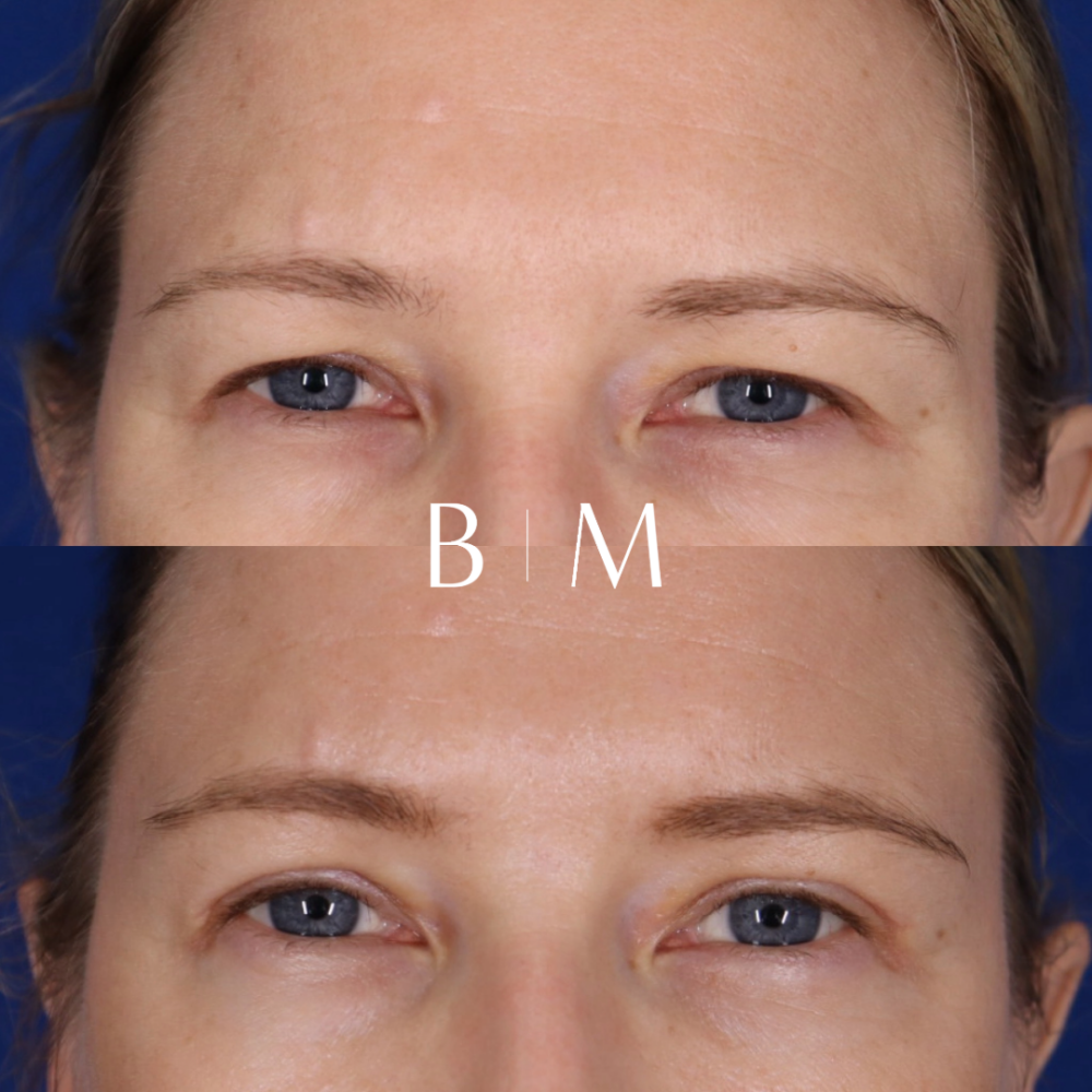 Blepharoplasty case #6508
