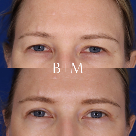 Blepharoplasty case #6508