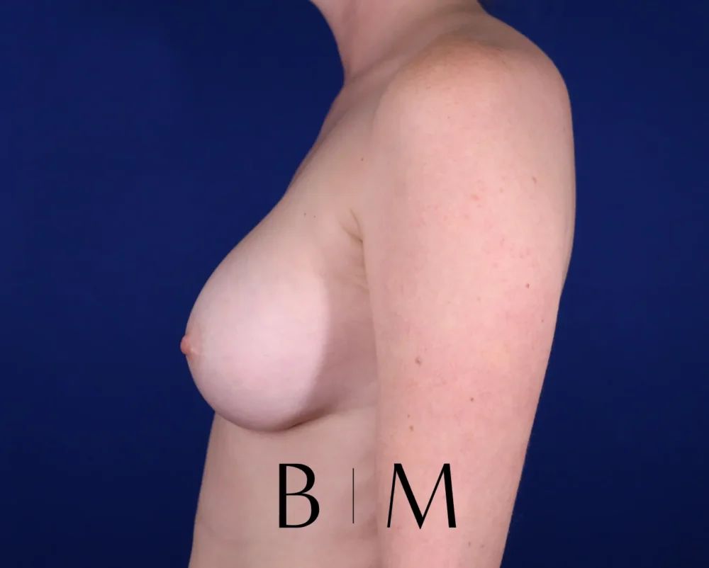 Breast Augmentation case #7293