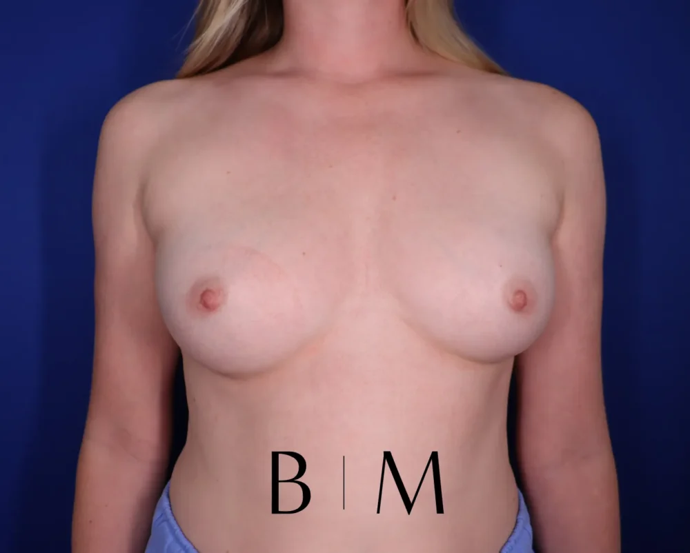 Breast Augmentation case #7293
