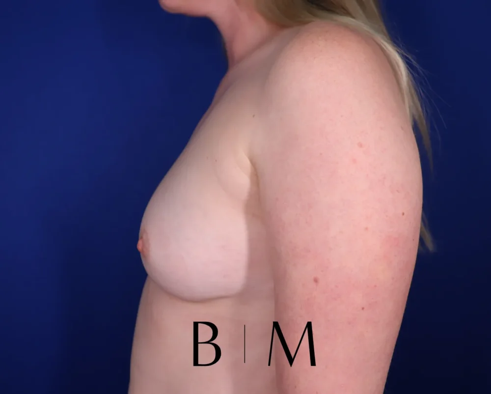 Breast Augmentation case #7293